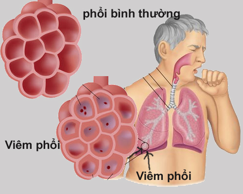 Viêm phổi bệnh viện - Hình ảnh minh họa